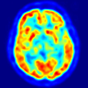 image: This is a transaxial slice of the brain of a 56 year old patient (male) taken with positron emission tomography (PET). The injected dose have been 282 MBq of 18F-FDG and the image was generated from a 20 minutes measurement with an ECAT Exact HR+ PET Scanner. Red areas show more accumulated tracer substance (18F-FDG) and blue areas are regions where low to no tracer have been accumulated.